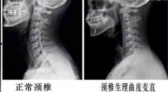 颈椎曲度变直锻炼视频,跟随视频轻松恢复健康曲线